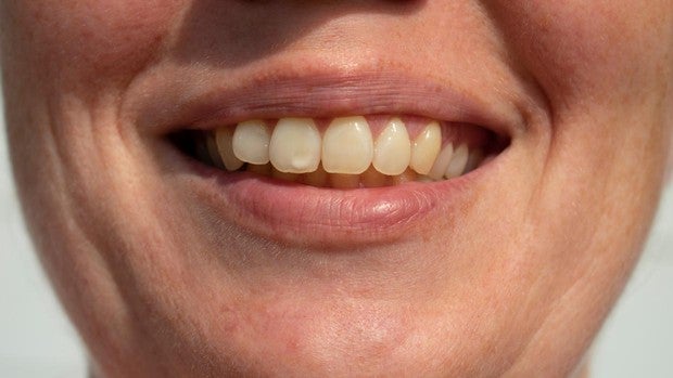 Manchas blancas en los dientes: por qué salen y cómo eliminarlas