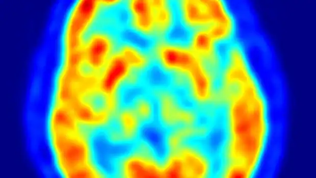 Resonancia cerebral en la que se aprecian los distintos niveles de actividad de varias zonas