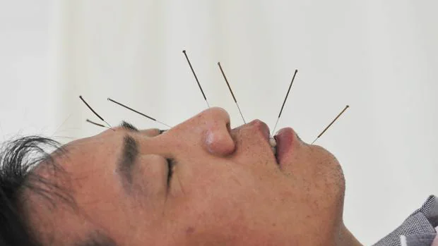 Un hombre se somete a una sesiónde acupuntura para corregir un problema de parálisis facial en un hospital en Shenyang (China)