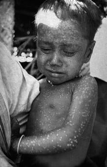 Rahima Banu, una niña de Bangladesh de dos años: fue la última persona atacada por el virus Variola major