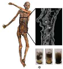 Esta figura muestra la preservación del tracto gastrointestinal y la textura del contenido del Hombre de Hielo. La imagen radiográfica muestra el estómago completamente lleno (asterisco). Debajo, las muestras de contenido del estómago (izquierda, asterisco) y de dos sitios diferentes en el tracto gastrointestinal inferior (centro, derecha)