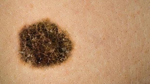 Descubren una relación entre los melanomas y la materia oscura