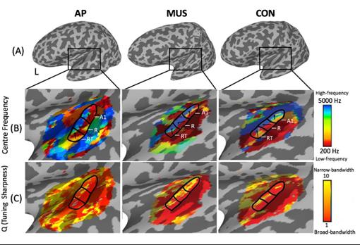 Las pruebas demostraron que el cerebro de los músicos con «oído perfecto» (AP en el dibujo) tenía una corteza auditiva mayor que el resto de músicos y de voluntarios con mínimas nociones musicales