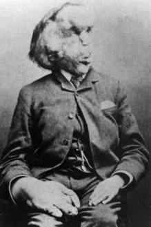 Joseph Merrick, fotografiado en 1889
