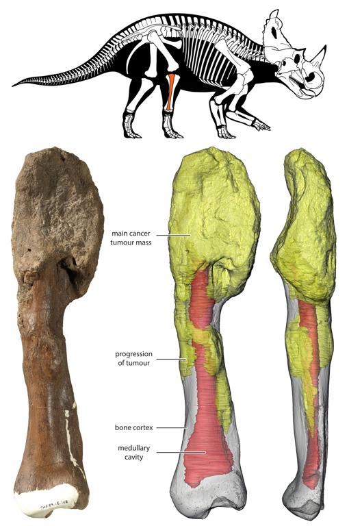 La masa tumoral principal está en la parte superior del hueso, y se puede ver en la reconstrucción 3D en amarillo; rojo gris es el hueso normal y rojo denota la cavidad medular.