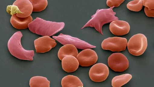 Los glóbulos rojos alargados de las personas con anemia de células falciformes pueden bloquear los vasos sanguíneos pequeños