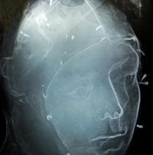 Imagen de rayos X que muestra los pequeños clavos en la cabeza