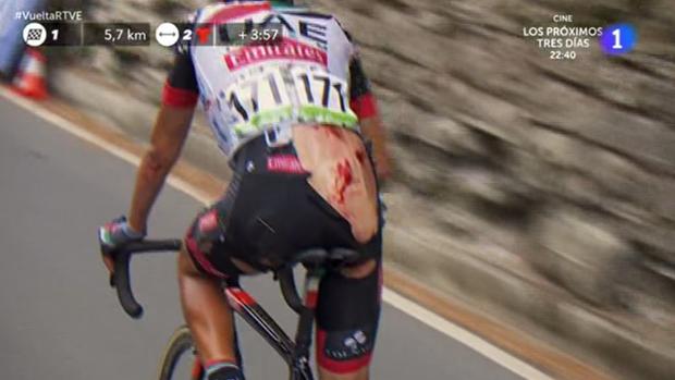 Así quedó la espalda de Fabio Aru tras una dura caida en La Vuelta