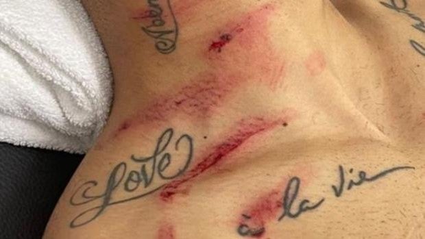 Así quedó el cuello y el pecho de Cunha tras una patada criminal