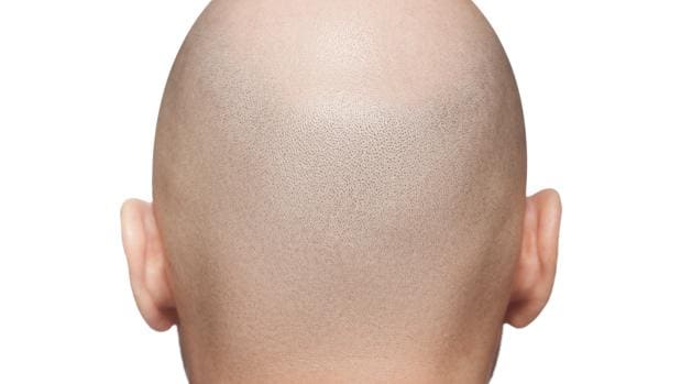 Existen diferentes tratamientos para la alopecia