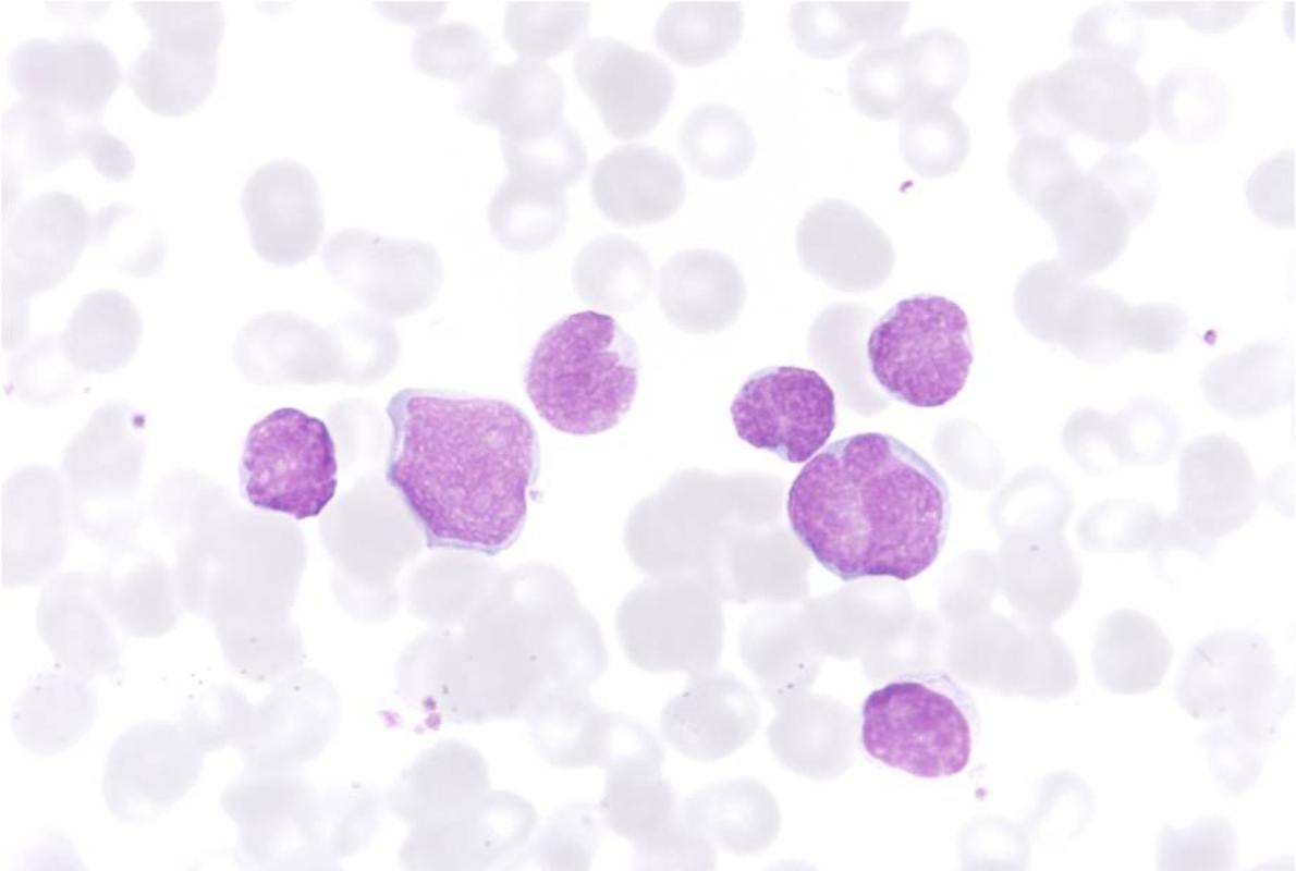 Ejemplo de leuicemia aguda tipo T (células cancerosas teñidas de violeta)