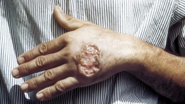Cerca de 1.400 inscritos en el congreso mundial sobre leishmaniasis en Toledo