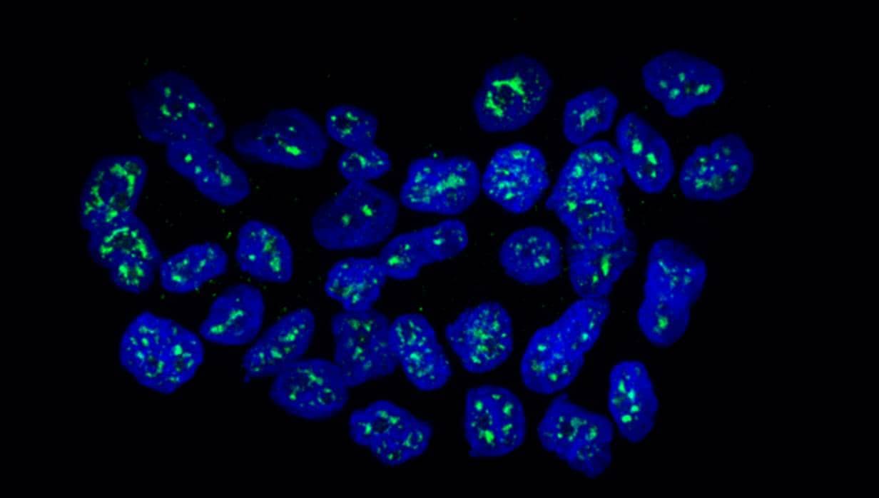 Un conjunto de células metastásicas de mama en el que está expresada la proteína (en verde)