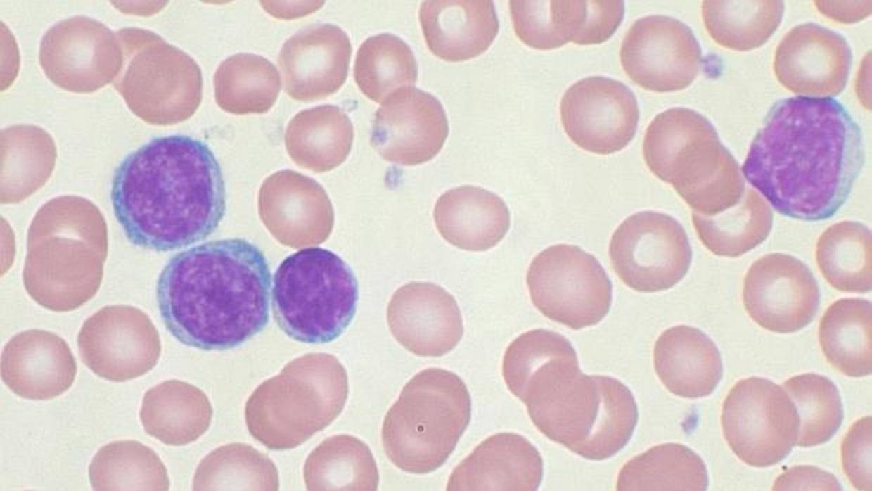 Imagen de células de la leucemia linfática crónica