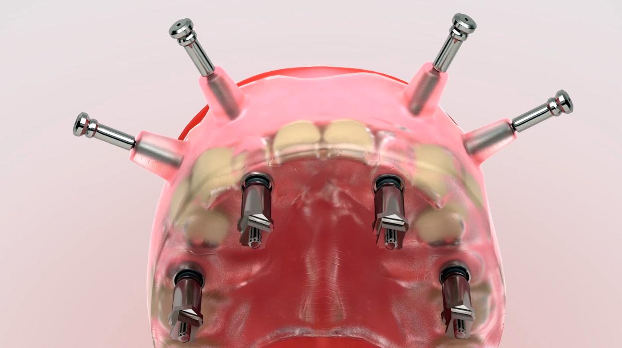 Una pesadilla de año y medio para que le pusieran unos implantes