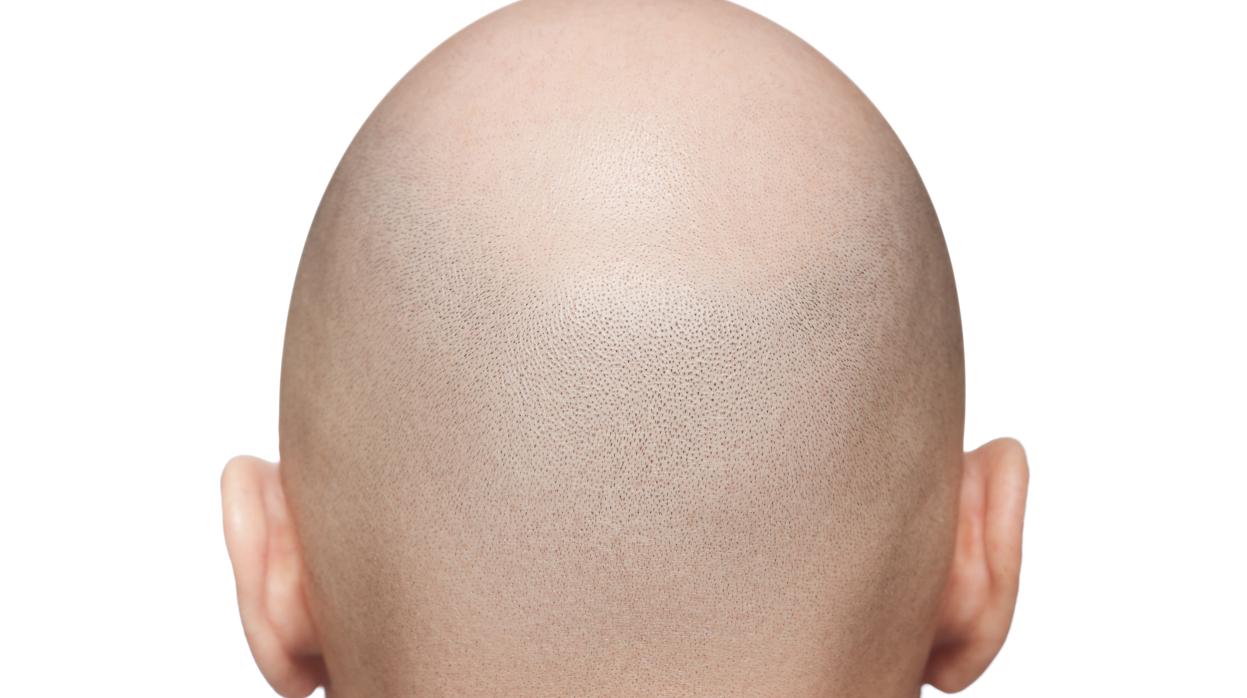 La alopecia ha sido el eje del curso realizado en el Hospital Ramón y Cajal
