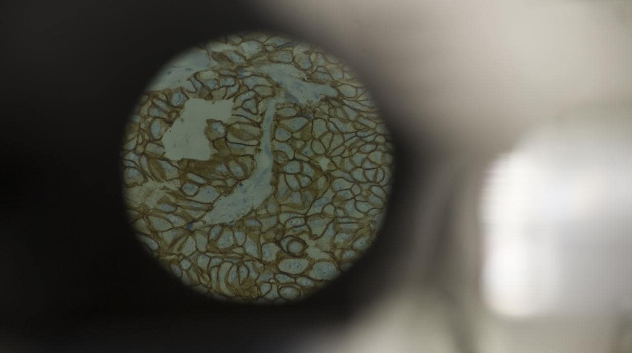 Vista a microscopio de una muestra de tumor de mama