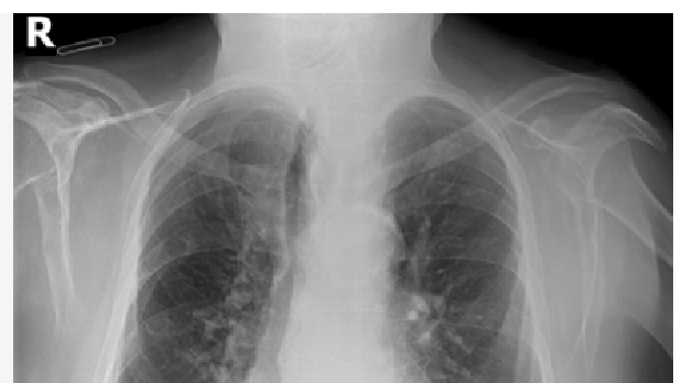 Inteligencia Artificial para la detección precoz de neumonía por COVID 19 con una radiografía simple