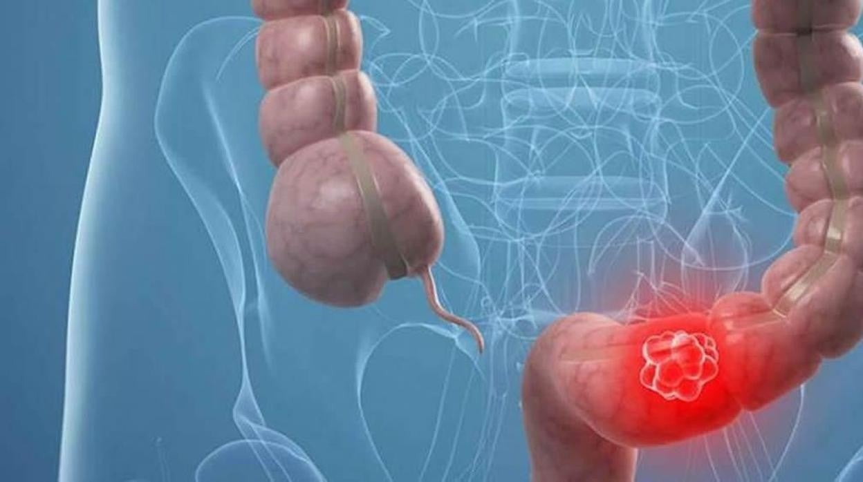 El Programa de Cáncer Colorrectal mejorará su diagnóstico a partir del otoño