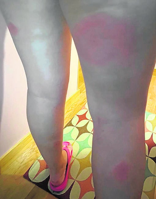 Las picaduras por mosca negras sufridas por Paula, una vecina de Villaverde