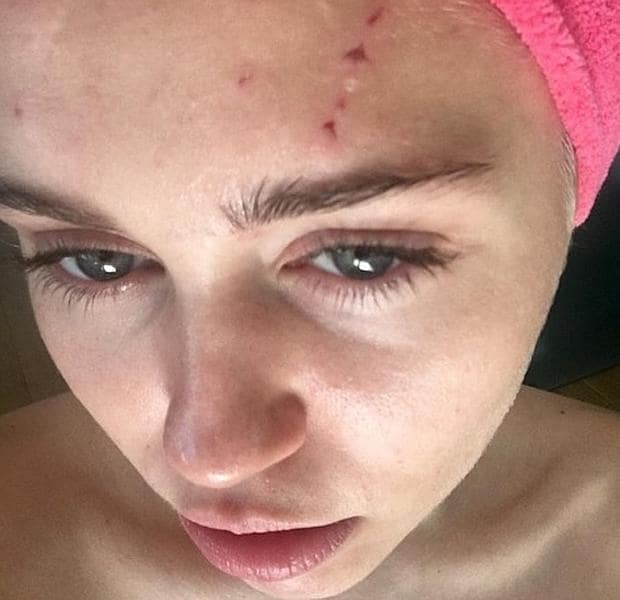 Miley Cyrus muestra las heridas que le hizo su gato tras una pelea