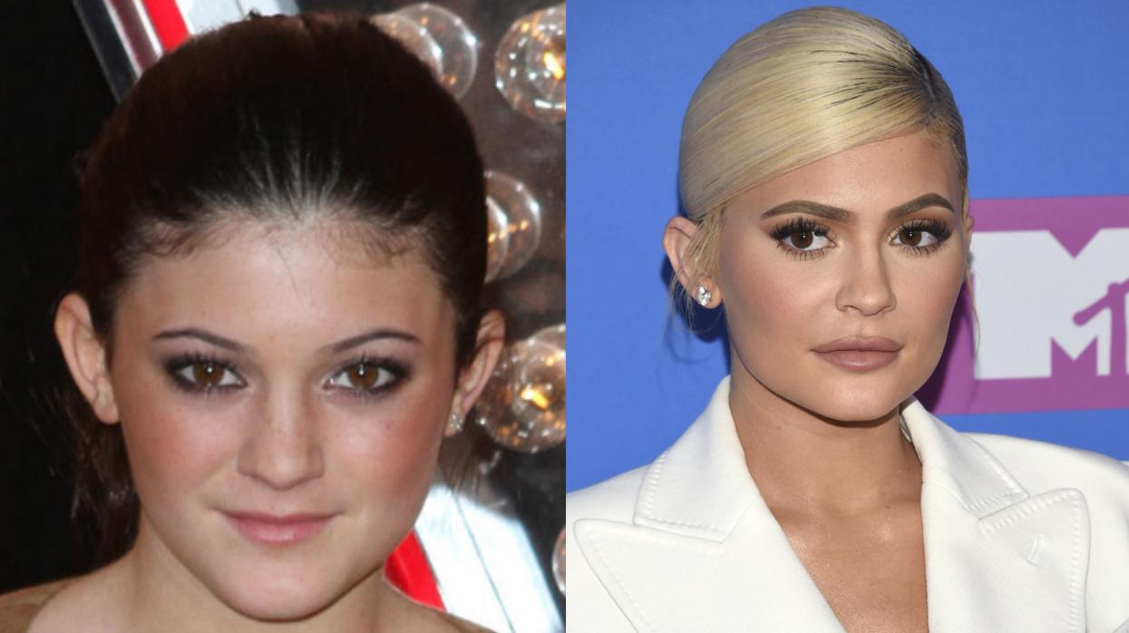 El antes y después de Kylie Jenner