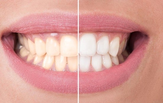 La salud de la boca cuando hacemos dieta