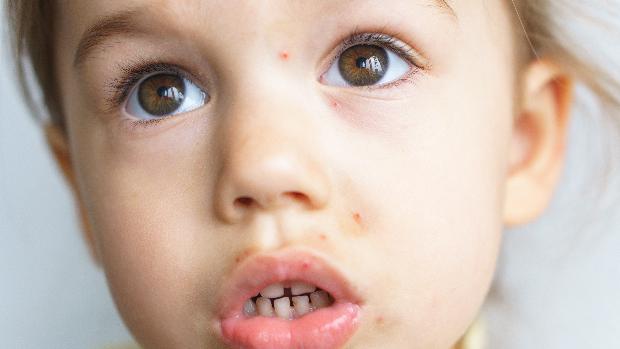 Nada de compartir toallas o de sentarse al borde de la piscina para evitar el molusco contagioso