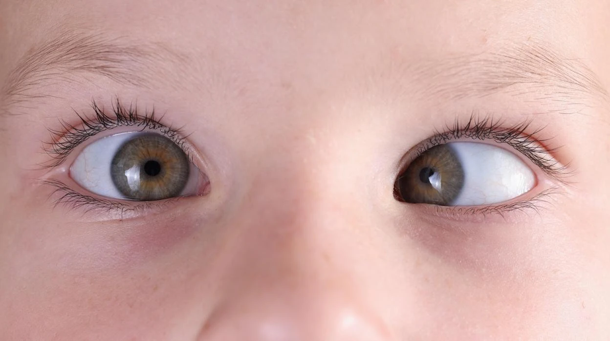 La advertencia de un oftalmólogo: un estrabismo en la infancia «no es normal nunca»