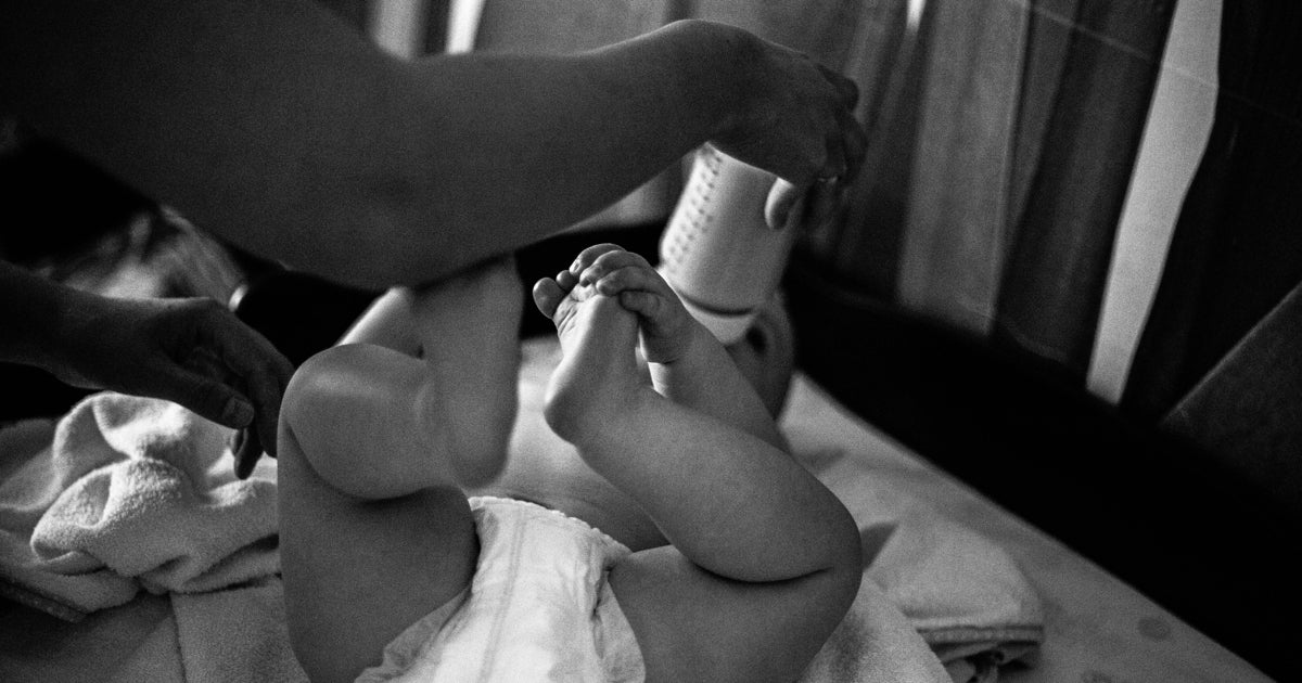 Cómo evitar la dermatitis del pañal del bebé