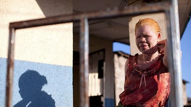 África no es un buen lugar para nacer albino