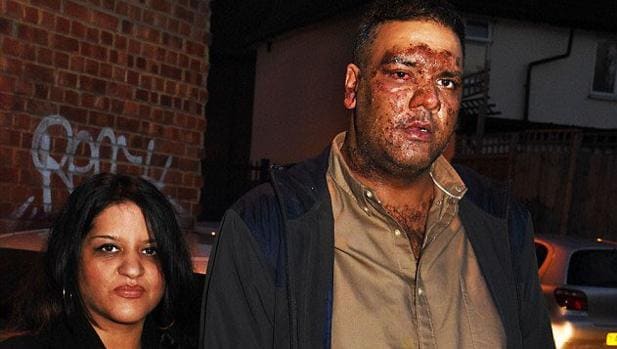 Imran Khan, británico de origen paquistaní, tras ser atacado con ácido por adolescentes en el Este de Londres