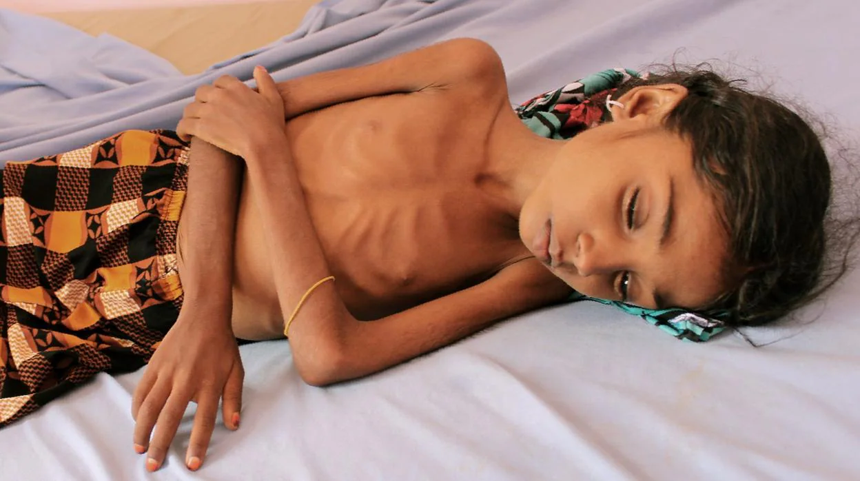 Una niña yemení que sufre malnutrición