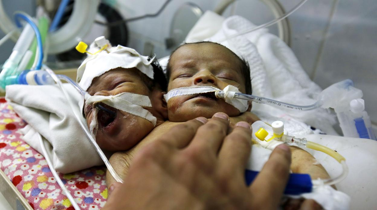 Los hermanos siameses se llamaban Abdul-Khaliq (derecha) y Abdul-Rahim. En la imagen, en su incubadora de la UCI neonatal del hospital Al Thawra en Saná (Yemen), antes de fallecer