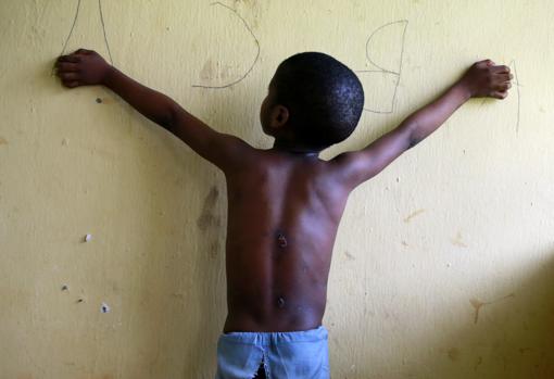 Niño, de seis años, librado, en el que se pueden apreciar las cicatrices de su espalda