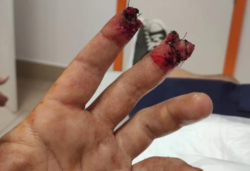 Estado de la mano de Jesús Rafael tras la intervención quirúrgica