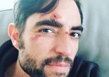 Dani Mateo, herido tras una actuación en Bilbao: «Tengo la cara hecha un eccehomo»