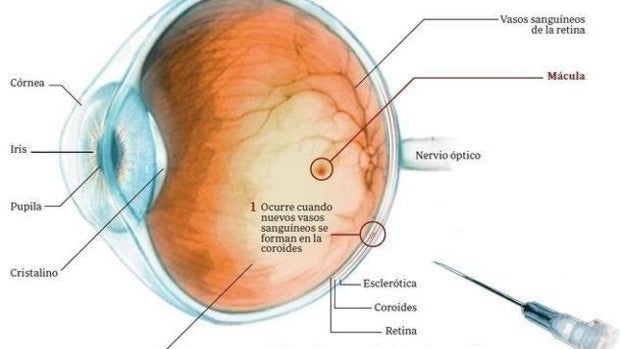 El Hospital Punta de Europa implanta una nueva terapia para tratar enfermedades de la retina
