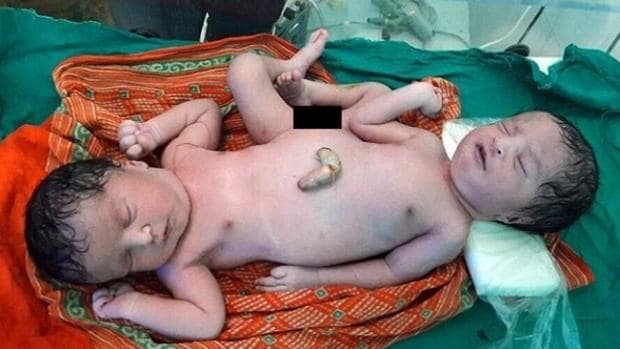 Foto de los siameses recién nacidos