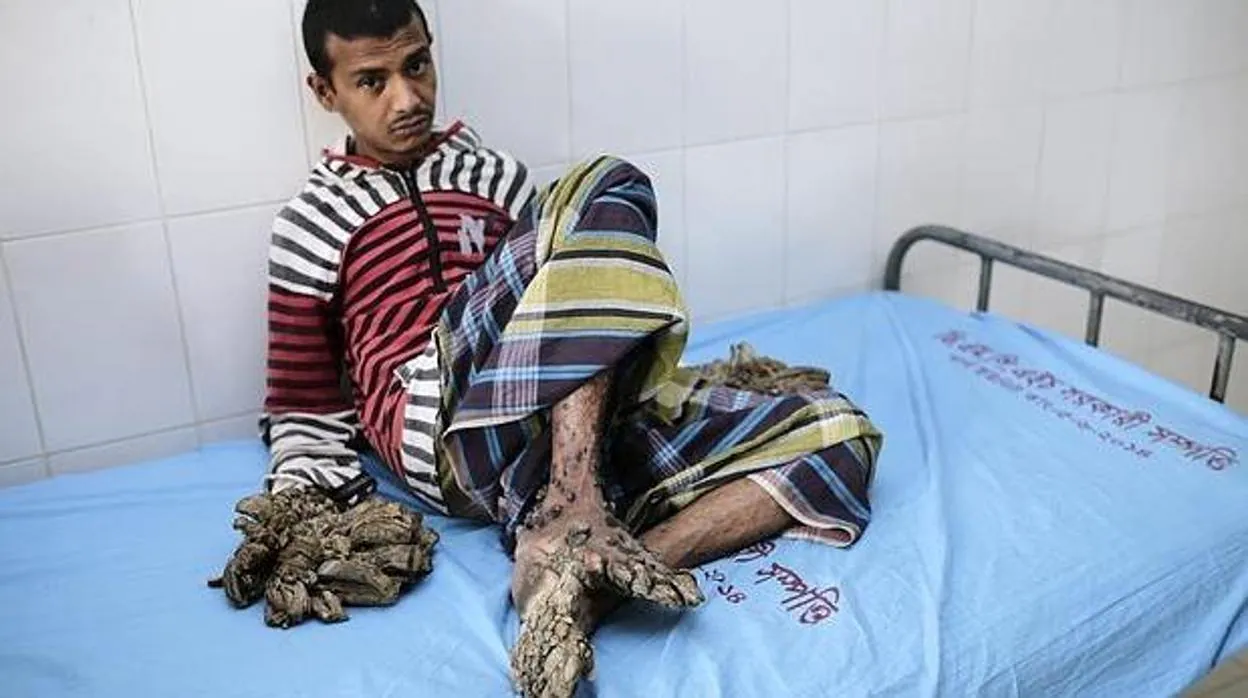 El «hombre árbol» de Bangladesh tendrá que volver a pasar por el quirófano sin esperanzas de curación