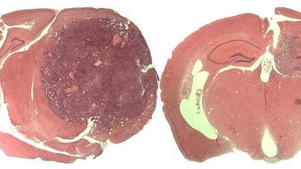 Un tumor en un cerebro de ratón no tratado (izquierda) creció mucho más que el tratado con el péptido NBD (derecha).