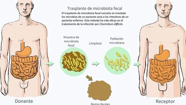 Trasplante fecal
