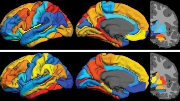 Imagen por PET de la proteína tau (arriba) y de las placas de beta-amilide en el cerebro de un paciente con alzhéimer