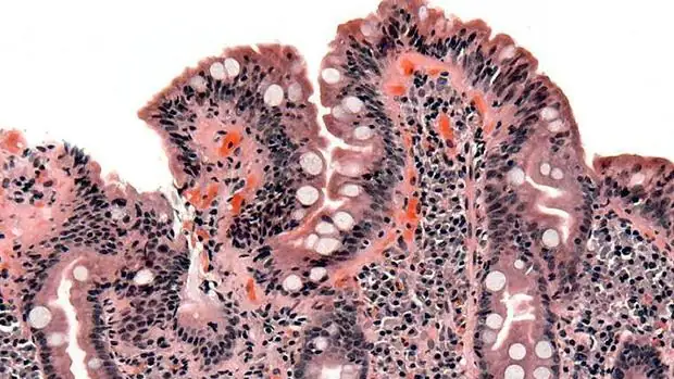 Biopsia de intestino delgado enfermedad celíaca que muestra deterioro de las vellosidades