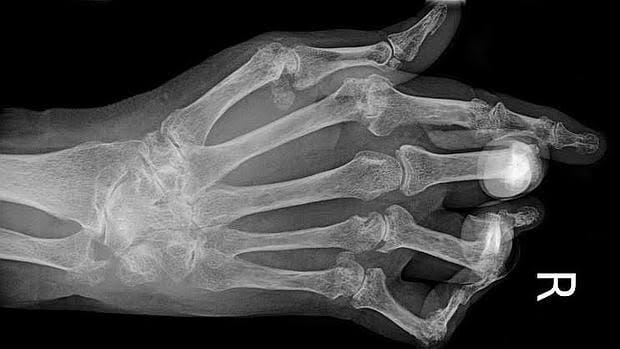 Radiografía de la mano de un paciente con artritis reumatoide