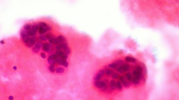 Identifican un mecanismo que permite al cáncer sobrevivir sin glucosa