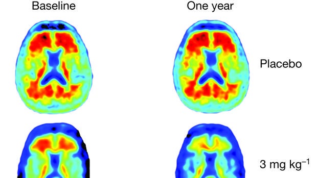 Una terapia detiene el deterioro cognitivo asociado al alzhéimer en pacientes