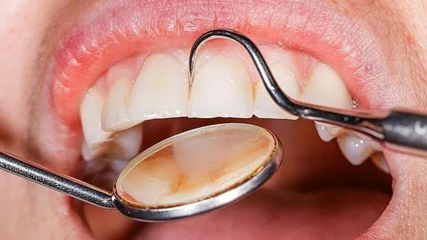 La gingivitis y la periodontitis pueden tener un origen diferente