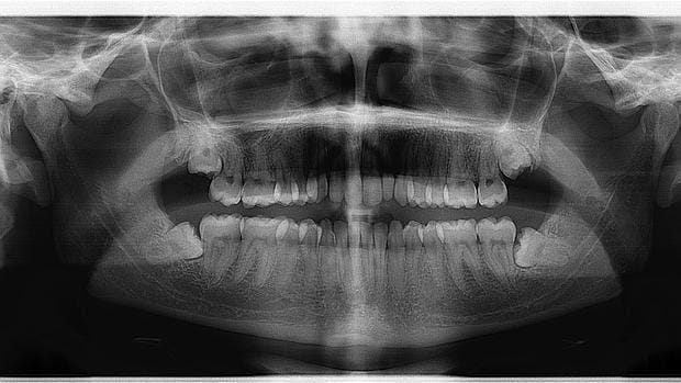 La periodontitis se asocia a un mayor riesgo de múltiples enfermedades
