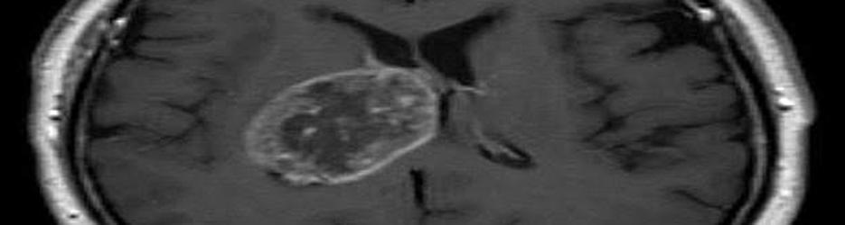 Glioblastoma multiforme